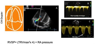 Frontiers Echocardiographic Evaluation Of Pulmonary Pressures And